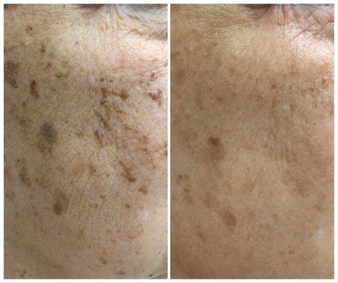 Laser photo rejuvenation, 2 sessions, 6 weeks apart @ CPMedSpa Laser & Skin. Text 910-347-5444 or visit CPMedSpa.com to book online.