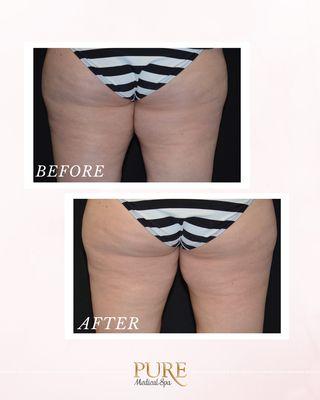 CoolSculpting - Inner and Outer Thighs