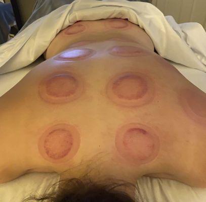 Cupping therapy