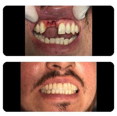 Teeth knocked out. Replaced with implants and crowns.