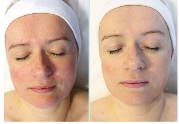 Red out facial for sensitive skin before & After.