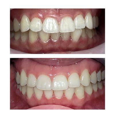 Invisalign case