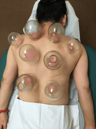 Cupping