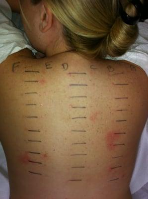 Allergy skin test (scratch) in an adult.  Duration of the test is 15 minutes