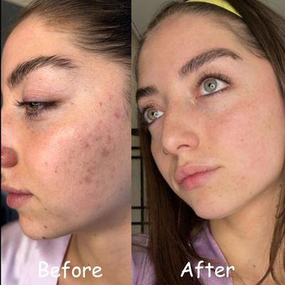 Acne and acne scars cleared after facial treatments