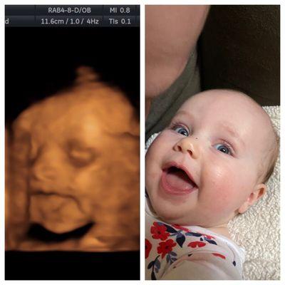 3D ultrasound at 25 weeks and baby at 5 months old