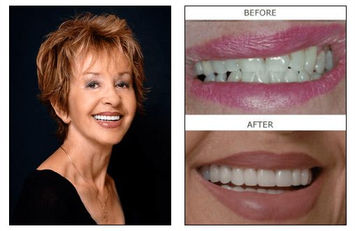 Porcelain veneers patient