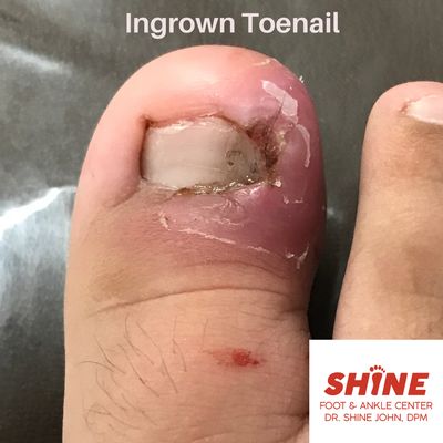 Ingrown Toenail issue - common in-office procedure with minimal down time for recovery.