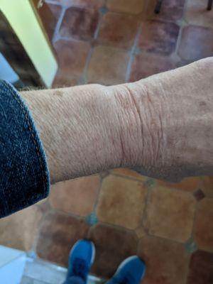 This is a picture of my wrist.  I never received my ID band.