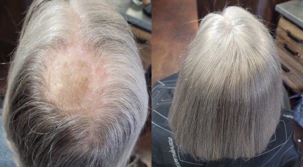 Custom Solutions for hair loss