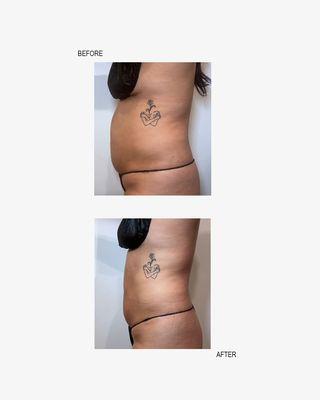 Our Weight Loss treatments provide a non-invasive option for spot reduction, offering precision and efficiency in addressing stubborn fat