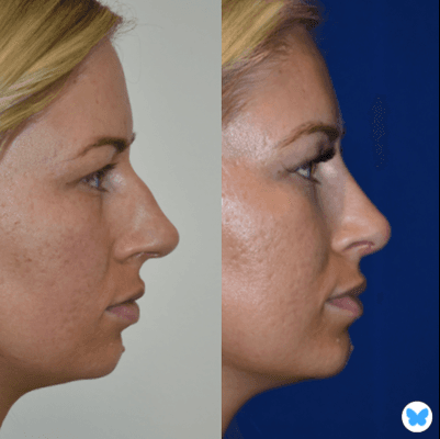 Rhinoplasty