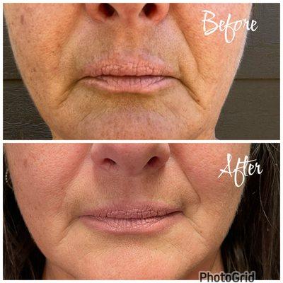 Beautiful results with Xeomin