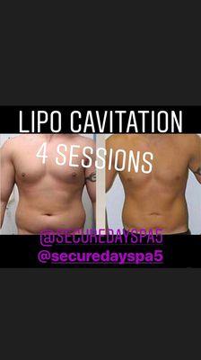 Lipo cavitation