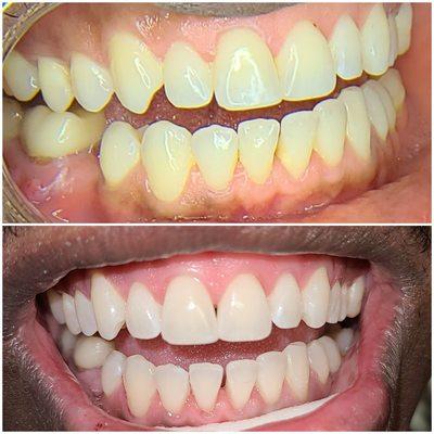 Cosmetic Teeth Whitening Therapy