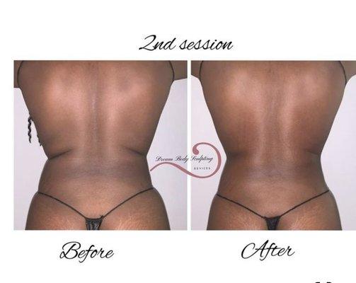 Cavitation treatment 
 Melts stubborn fat