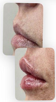 Sculpt and shape with lip
Filler.