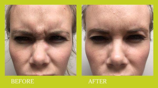 Botox before and after in a woman in her 20's.