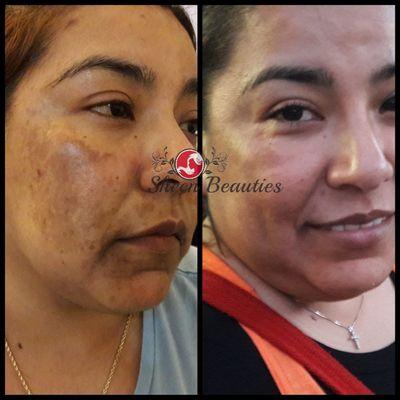 90 days skin treatment