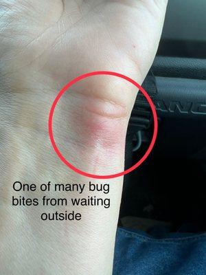 One of many bug bites from waiting outside (customers are not allowed inside)