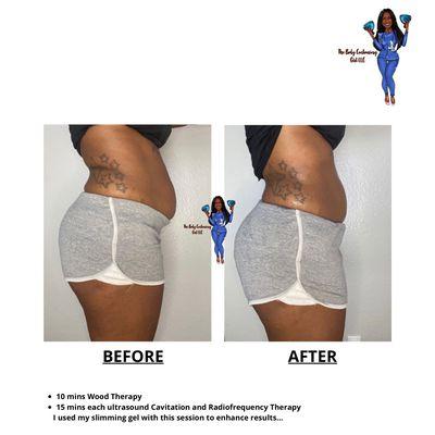 The Body Contouring Girl