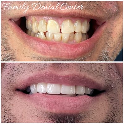 Before and after smile design.