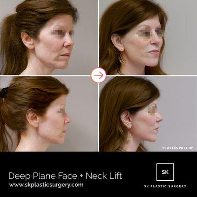 Before and after of Deep Plane Face and Neck Lift Surgery.