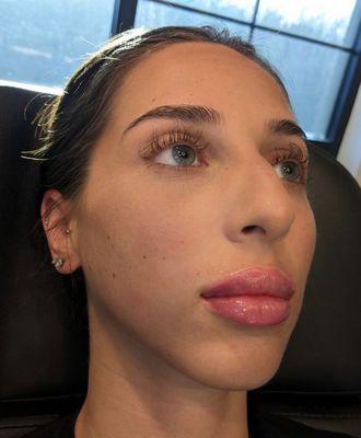 Lip Filler Immediate Results