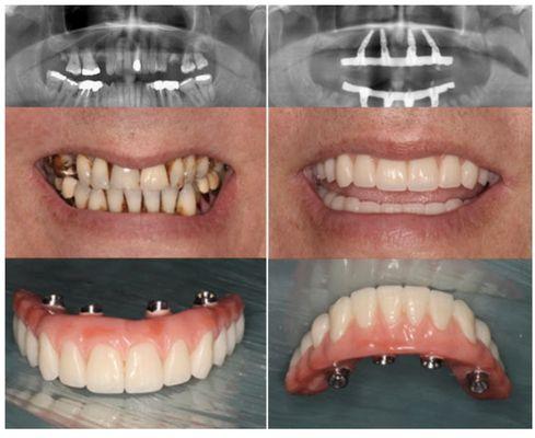 All on 4 Fixed Implant teeth