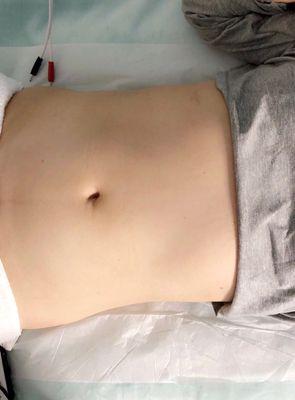 Microcurrent Body Transforming Treatment After