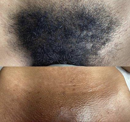 Full Brazilian Wax (Top-Before/Bottom-After)