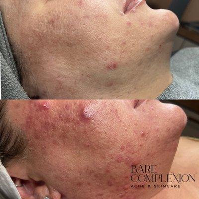 Acne facial at Bare Complexion Acne & Skincare located in Ventura, California