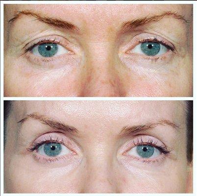 Upper eyelid hooding corrected with blepharoplasty and lower eyelid texture resurfaced with Erbium laser