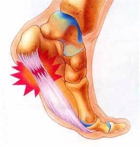 plantar fascitis