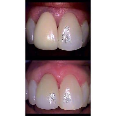 Before/after.  Patient unhappy w/ old crown.  Whitened teeth with Zoom & replaced crown with Cerec same day porcelain, custom stained crown.