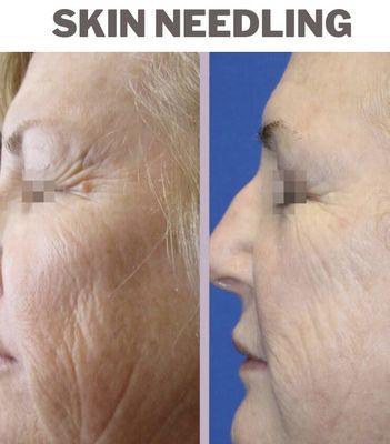 Skin needling for fine lines