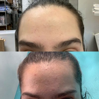 Before and after 1rst golden  facial treatment