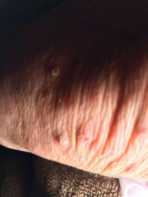 Photo of knee with thickened skin and very old typical scabies bumps