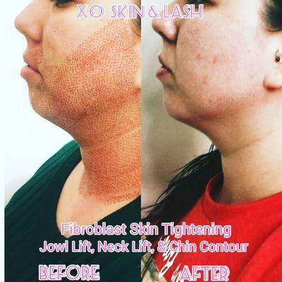 6 week progress photo of my awesome client that I jowl lift, neck lift, chin contour, and lip flip treatment to