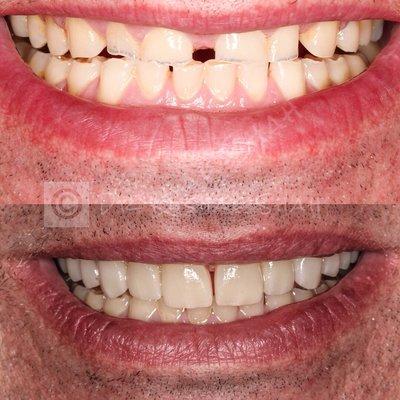 Life changing Smile Makeover