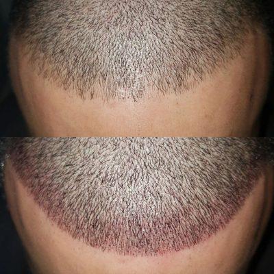 Filled in his hairline for a fuller hairline & clean look with scalp micropigmentation! Subtle changes made a huge difference!