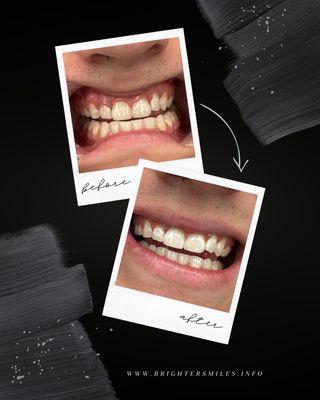 Brighter Smiles Teeth Whitening