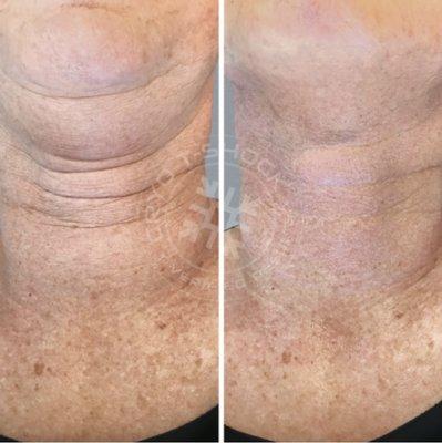 Neck tightening treatment before and after