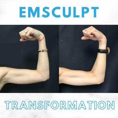 Before and after 4 EMSCULPT body contouring treatments on the arms to define bicep and tricep muscles.