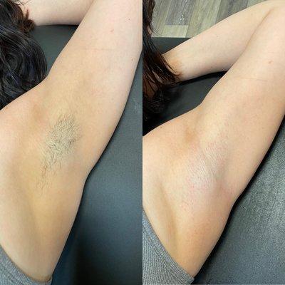 Before and after of underarm