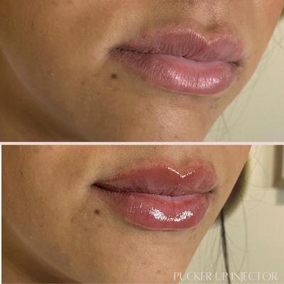 Switching up angles and loving the results!  Cheers to these gorgeous lips enhanced with Versa, 0.7 ml! Embracing the beauty!