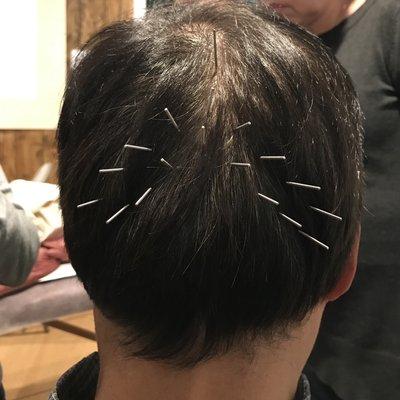 Scalp Acupuncture.  The above points treat Bell's Palsy.