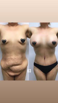 Tummy Tuck and breast Augmentation before and after from a patient of Dr.Sayeg