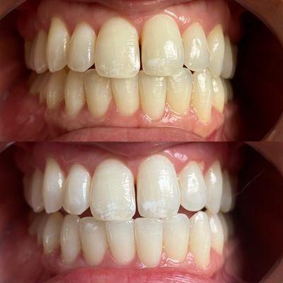 Before and after first teeth whitening treatment