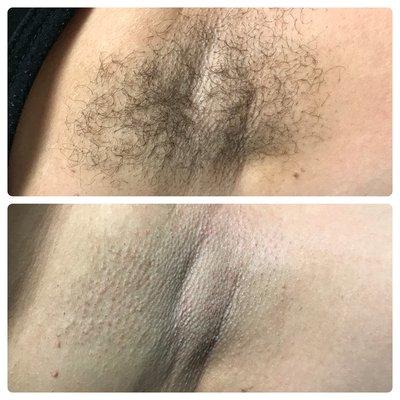 First time client underarm waxing, before and after results.